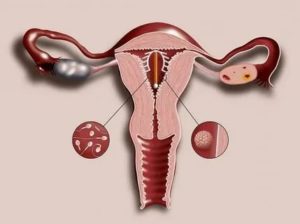 Плюсы и минусы гинекологической спирали