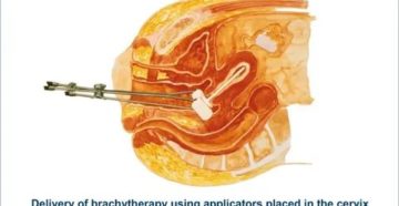 Брахитерапия рака шейки матки отзывы специалистов