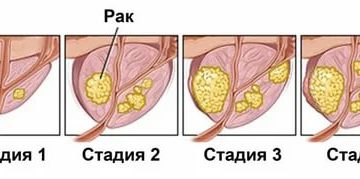 Терминальный рак предстательной железы