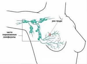 Лимфаденэктомия при раке молочной железы