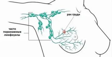 Лимфаденэктомия при раке молочной железы