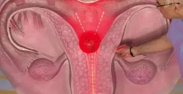 Могут ли быть месячные после удаления матки с одним яичником