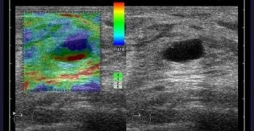 Узи молочных желез с эластографией стоимость