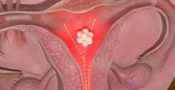 Что означает покалывание в матке после месячных