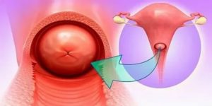 Воспаление цервикального канала при климаксе