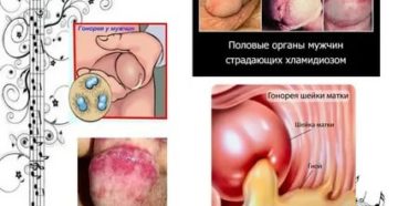 Можно ли заразиться венерическими от мочи
