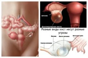 Как понять что фолликулярная киста рассосалась во время месячных