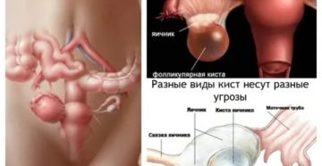 Как понять что фолликулярная киста рассосалась во время месячных Как понять что фолликулярная киста рассосалась во время месячных