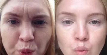 Можно ли делать ботокс во время месячных отзывы