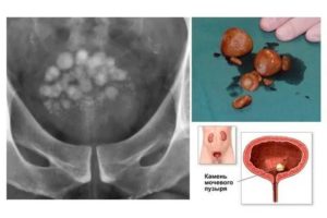 Как отличить песок в мочевом пузыре от цистита