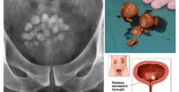 Как отличить песок в мочевом пузыре от цистита