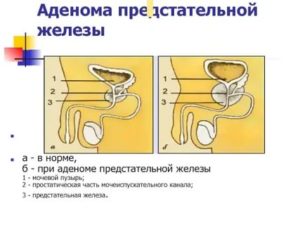 Лечение аденомы предстательной железы солевыми повязками