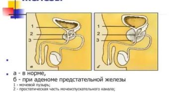 Лечение аденомы предстательной железы солевыми повязками