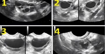 Узи фолликула фолликулогенез контроль овуляции что это