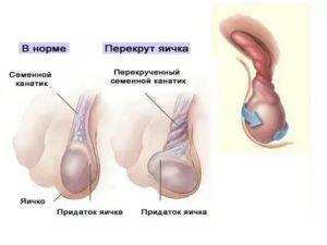 Может ли быть перекрут яичка если уже была такая операция
