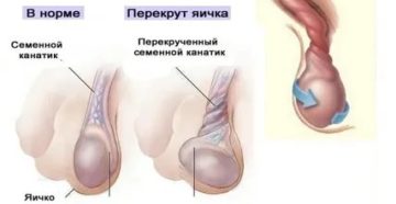 Может ли быть перекрут яичка если уже была такая операция