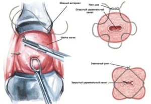 Как проходит операция по наложению шва на шейку матки