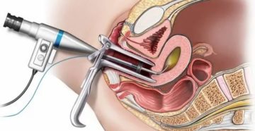Гистероскопия матки на какой день проводят