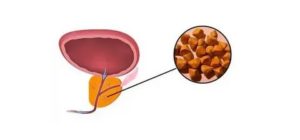 Конкременты в предстательной железе что это такое