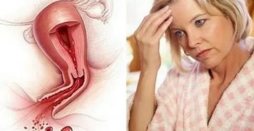 Как лечить обильные месячные при менопаузе