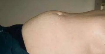 Может ли быть вздутие живота при цистите у