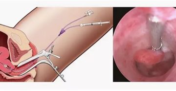 Удаление плацентарного полипа матки гистероскопией