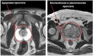 В каких случаях делают мрт предстательной железы