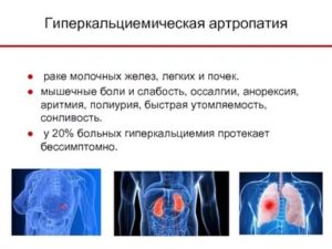 Гиперкальциемия при раке молочной железы