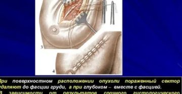 Что такое местная анестезия при операции на молочной железе