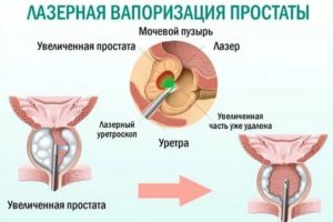 Трансуретральная плазмокинетическая вапоризация аденомы простаты