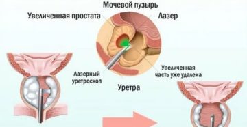 Трансуретральная плазмокинетическая вапоризация аденомы простаты