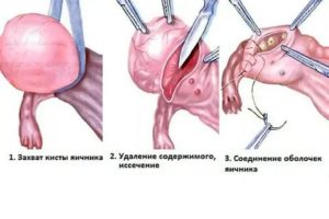 Что такое гистология в гинекологии после удаления кисты