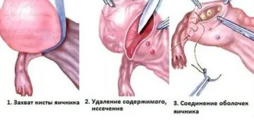 Что такое гистология в гинекологии после удаления кисты