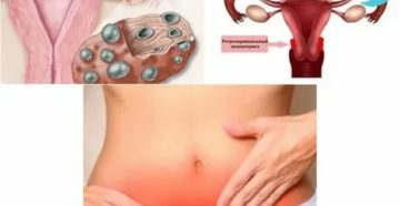 Почему могут болеть яичники у женщин после месячных