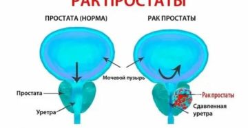 Можно ли жить половой жизнью при раке предстательной железы