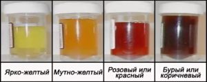 При простатите может моча быть темная моча