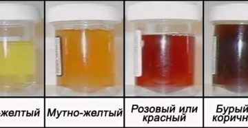 При простатите может моча быть темная моча