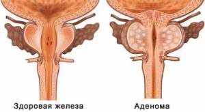 Может ли аденома простаты перерасти в злокачественную опухоль