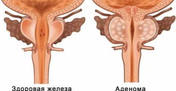 Может ли аденома простаты перерасти в злокачественную опухоль