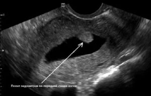 Могут ли перепутать беременность на ранних сроках с полипом матки на узи