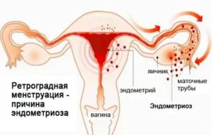 Что такое ретроградными менструациями