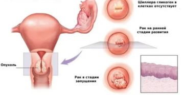 Что такое распад опухоли рака шейки матки