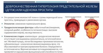 Признаки хронического простатита гиперплазия периуретральных желез
