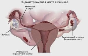 Можно ли вылечить гиперплазия эндометрия кисты левого яичника