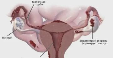 Можно ли вылечить гиперплазия эндометрия кисты левого яичника