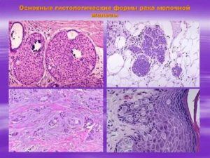 Что показывает гистология опухоли молочной железы