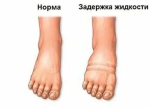 Почему сильно отекают ноги перед месячными