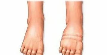 Почему сильно отекают ноги перед месячными Почему сильно отекают ноги перед месячными