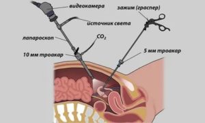 Лапароскопия по удалению эндометриоза стоимость