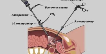 Лапароскопия по удалению эндометриоза стоимость
